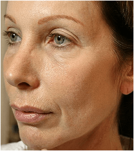 Thermage  Skin Tightening Treatment